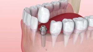 Dental Implant Candidacy, Placement, & Recovery