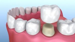 Dental Crowns
