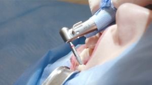 How Long Do Dental Implants Last?