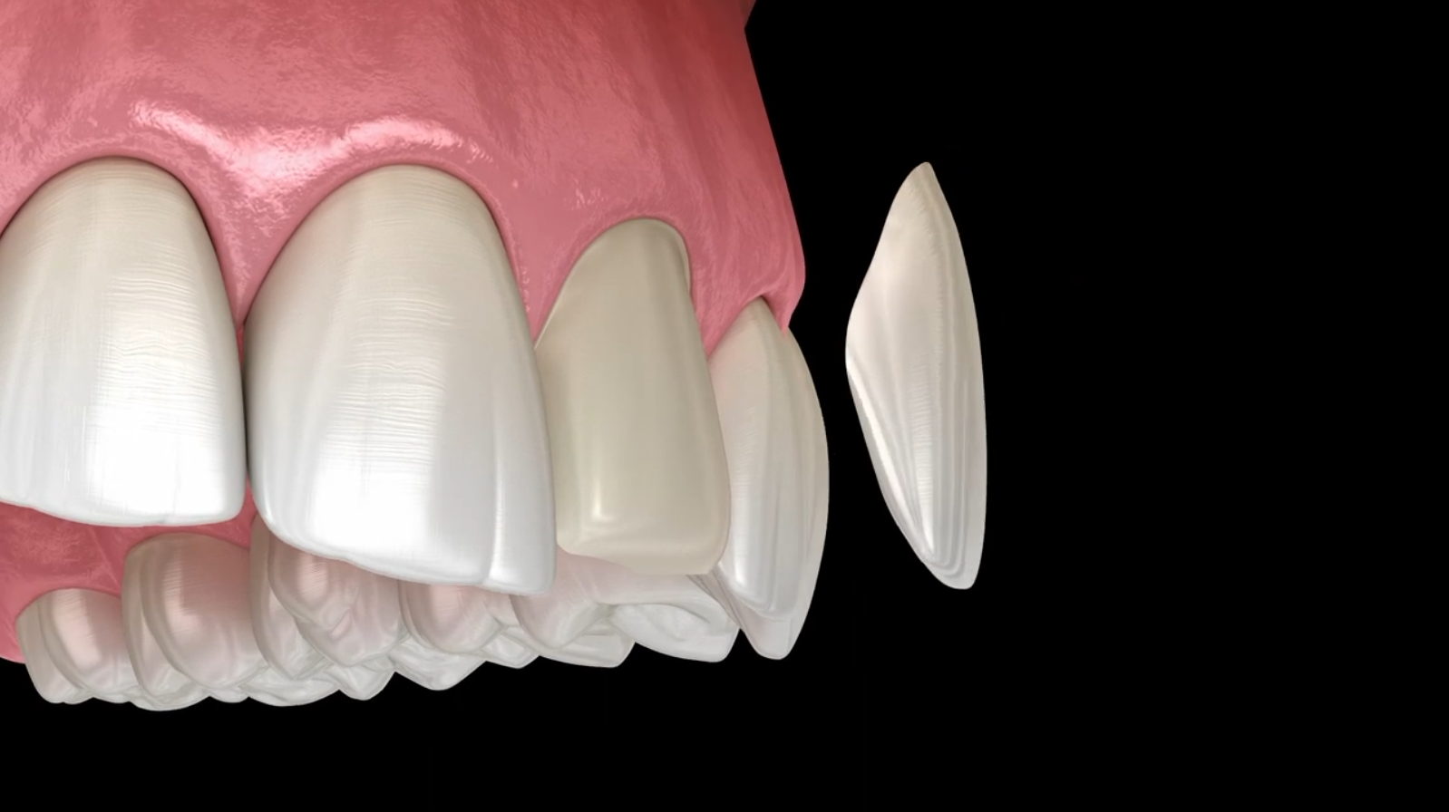 Porcelain Veneers Montreal, QC Montreal Smiles