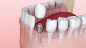 Implants Dentaires : Candidature et Récupération