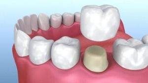 Dental Crown and Bridge Placement
