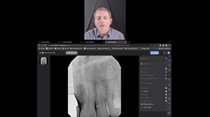 AI Improves How We Use Dental X-Rays