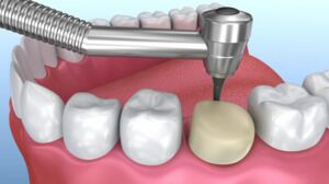 Brand-New Crowns in Just One Appointment
