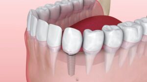 Dental Implants Are a Revolutionary Treatment