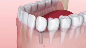 Fill Gaps in Your Smile With Dental Implants