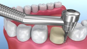 Premium Dental Crowns & Bridges