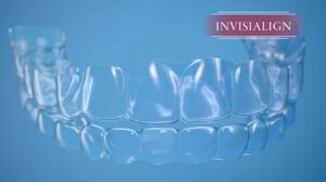 Invisalign Aligners Are a Discreet Treatment Option