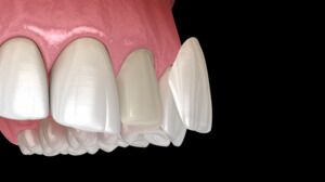 Custom Veneers Can Optimize the Appearance of Your Smile