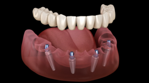 Restore Your Smile in One Day With All-on-4