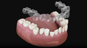 A Look at the Invisalign Advantage
