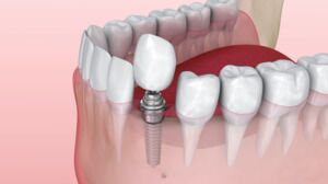 The Best Way to Replace Lost Teeth