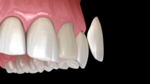 Veneers by a Master Ceramist