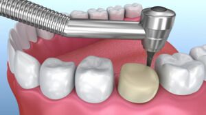 Lifelike Dental Crowns to Protect Your Smile
