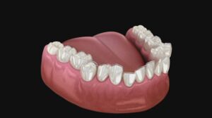 Subtle Smile Alignment With Invisalign