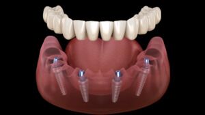 Customized All-on-X Implant Treatment
