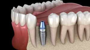 Replace Missing Teeth With Implants
