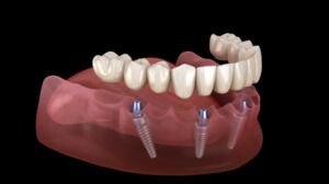 Restore Your Smile With All-on-4 Dental Implants