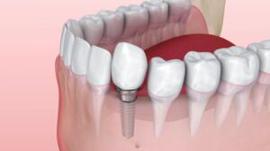 A Landmark Treatment Explained