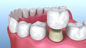 Bridges and Crowns V2