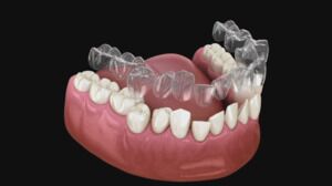 Aligners V1