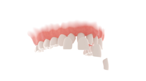 Porcelain Veneers