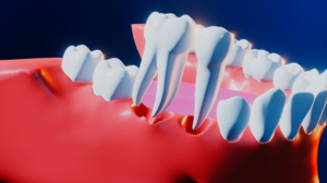 Remove the Tooth & Place the Implant on the Same Day