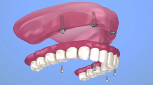 All-on-4 Implants