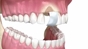 Bone Grafts