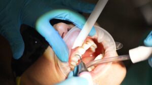 Crown Lengthening
