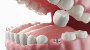 Implants