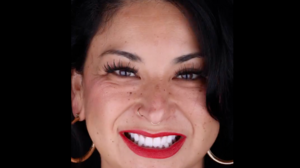 Paulina's Full Mouth Zirconia Crowns: Finally Taking Mom's Advice